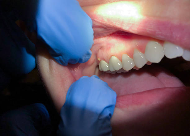 Best Emergency Gum Treatment in North Conway, NH